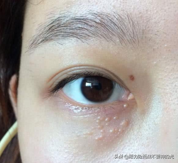 毛孔芝麻:毛孔里反复挤出来的“小米粒”，到底是什么东西？