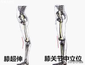 膝关节超伸困扰好多年,连紧身裤都不敢穿,该怎么办？