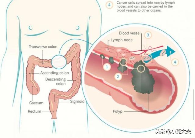 大便不成形粘马桶:舌苔厚腻、大便不成形是湿气重吗？怎么祛除湿气？