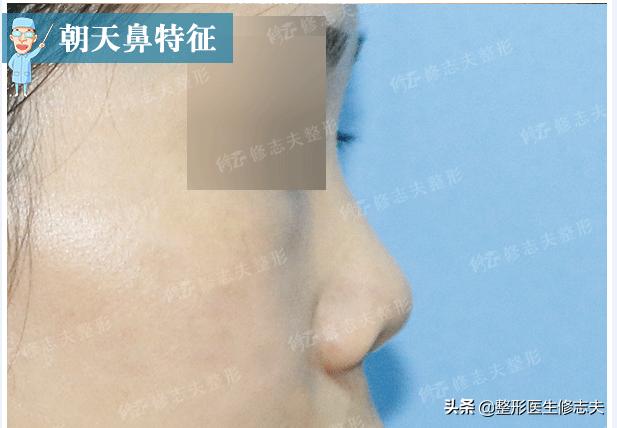 韩佳人资料:如何确定自己适不适合隆鼻
