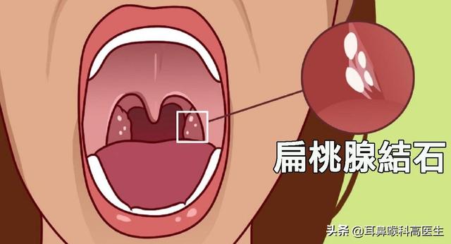 头条问答 扁桃体结石能用棉签挤出来吗 130个回答
