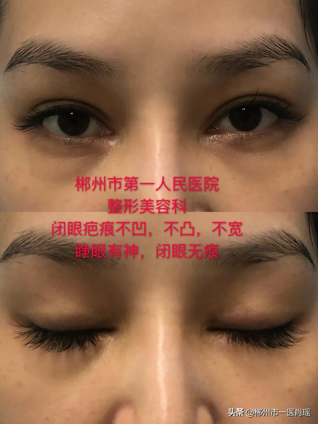 杨幂隆胸前后:整容一眼就能看出来，有什么根据？