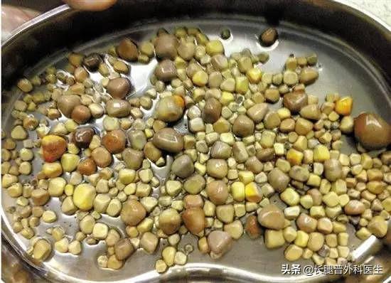 老人尿结石治疗方法:尿结石有什么症状？如何应对？