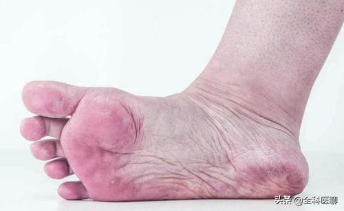 头条问答 - 脚上出现哪些表现是血栓"前兆"?什么样的人要重视血栓?