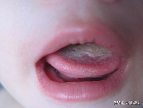 头条问答 - 宝宝舌头尖,上鄂,嘴唇上起口疮,吃母乳都疼,哭闹的很厉害