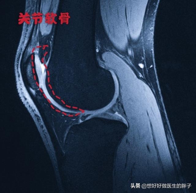 膝盖软骨磨损微创手术费用:膝关节前交叉韧带的损伤与治疗？