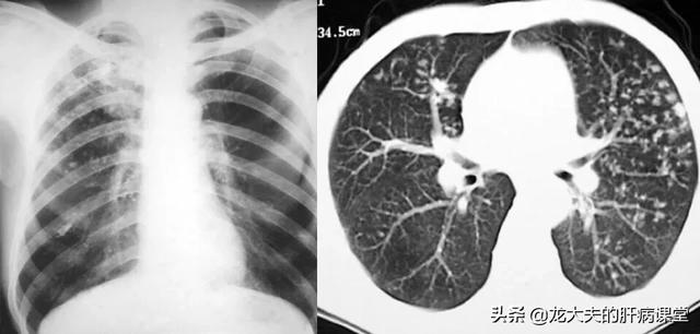 肺結核為什麼危險，對健康有哪些危害？