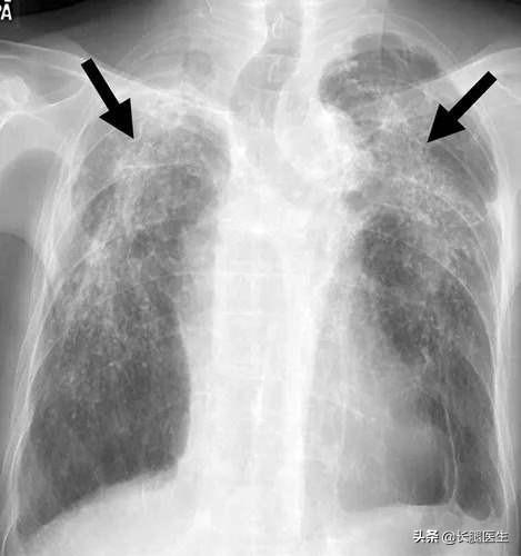 尘肺病的早期症状，尘肺病是怎么引起的？一旦得了尘肺病就必死无疑吗？