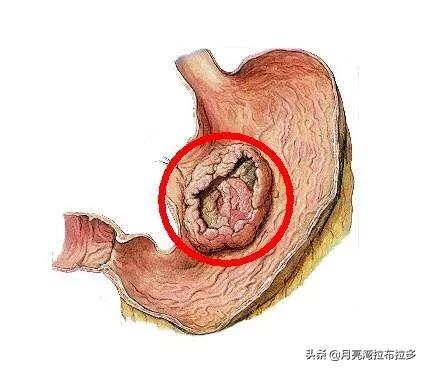 胃溃疡发生癌变会有征兆吗?-芃睿知识网