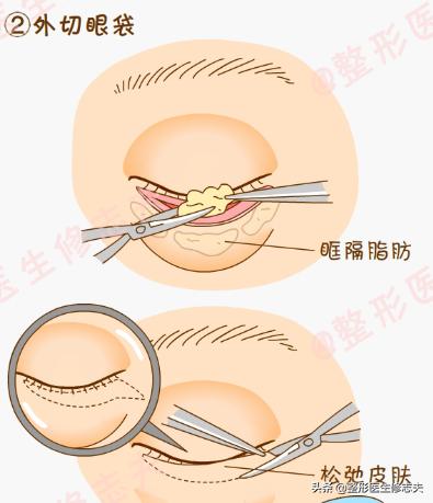 眼袋很严重，如何消除眼袋