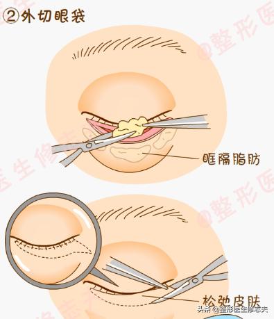 眼袋很严重，如何消除眼袋