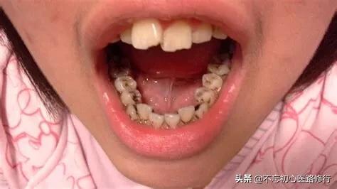轻度四环素牙是什么颜色:四环素牙涂什么颜色的口红 什么是牙齿美白，什么样的牙齿适合美白？