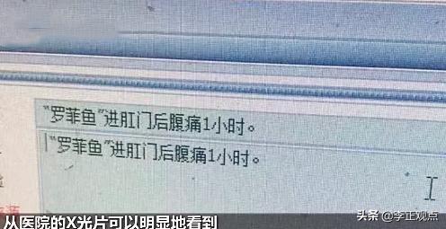 广州市第一人民医院吴好运医生:广东一男子腹痛难忍求医，体内竟发现非洲鲫鱼，怎么回事？