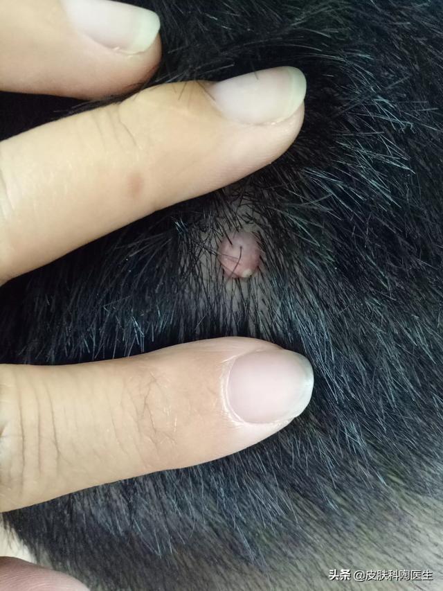 头皮长了个小肉瘤,是啥原因,需要切除吗？