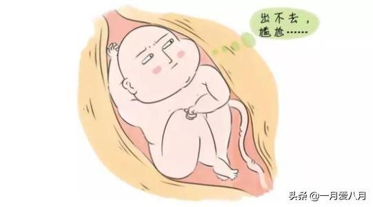 肩难产:肩难产的七步处理方法 顺产需要在什么情况下侧切？