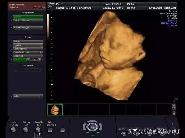此时也是筛查胎儿心脏的最佳时期,可以检查出胎儿是否畸形,发育是否