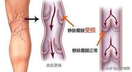 静脉曲张的消炎药有哪些:为什么静脉曲张患者要穿弹力袜？