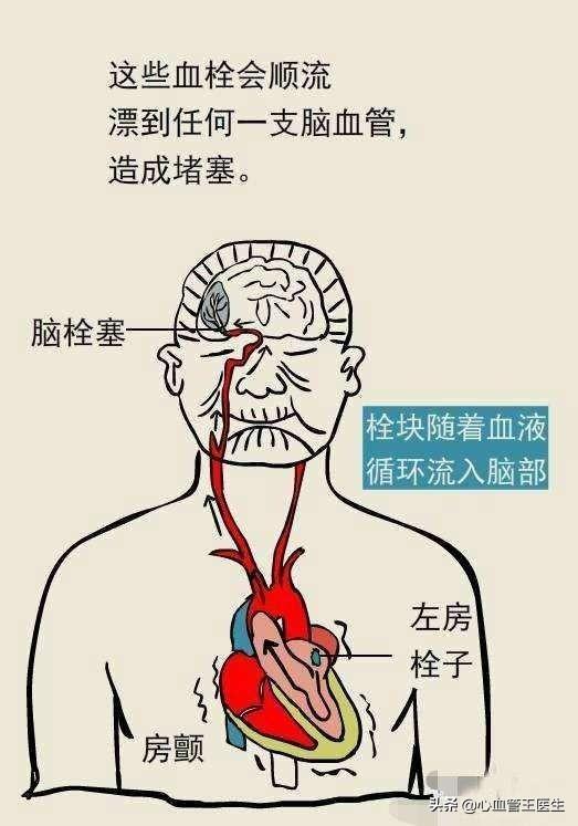 头条问答 慢心率房颤与快心率房颤哪个严重 23个回答