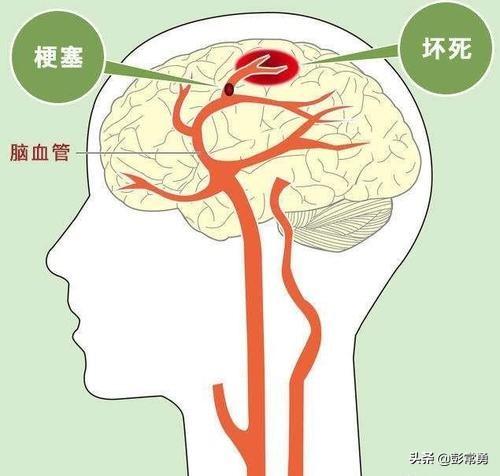 脑梗要怎么查出来：脑梗能查出来吗