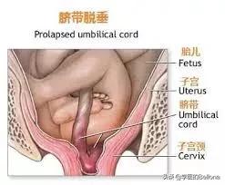 脐带脱垂是什么意思，脐带有什么重要性以及可能引发的问题是什么？