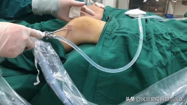 患了骨性关节炎怎么治疗:关节坏了，走不动路了怎么办？骨关节炎吃药还是手术好？