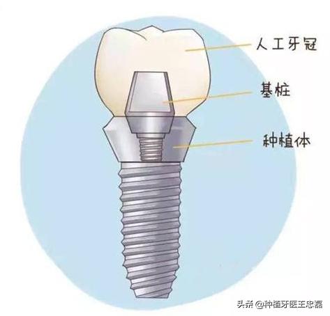 下門牙只有3顆牙齒原因為什麼牙結石總是在門牙下四顆呢