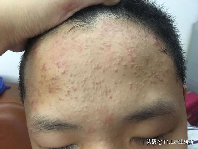 高中生的我臉上一直反覆長痘痘嘗試了很多藥物但只能治療表面漸漸的不