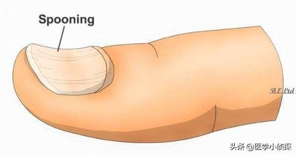 指甲凹陷是怎么回事:手指甲出现横向的凹陷是怎么回事