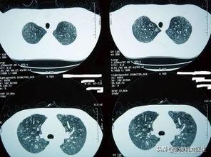 新型肺炎体温多少算正常:没有其它症状发热37.5，是新型肺炎吗？