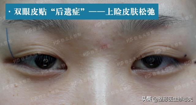 古巨基割双眼皮:长期贴双眼皮贴最后都会走上割双眼皮的路吗
