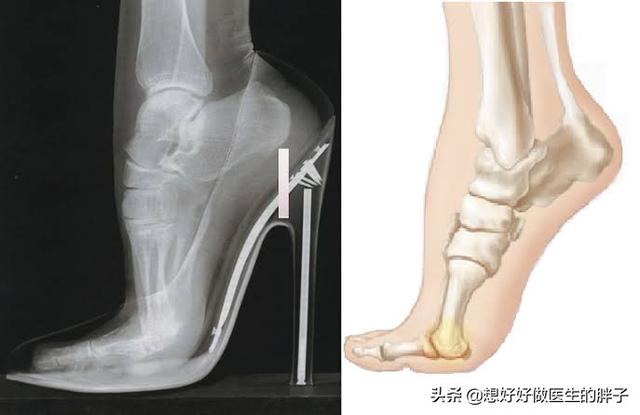 膝盖软骨磨损和风湿什么区别:不跑步的人膝关节也磨损、坏死，该怎么解释呢？