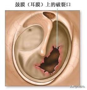 耳膜破了会聋吗,耳膜穿孔后是不是就聋了？