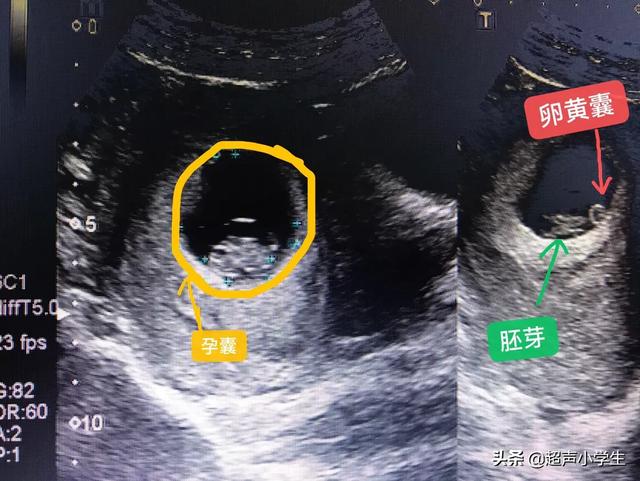 头条问答 怀孕四周可以看到孕囊吗 应该注意哪些事项 超声小学生的回答 0赞