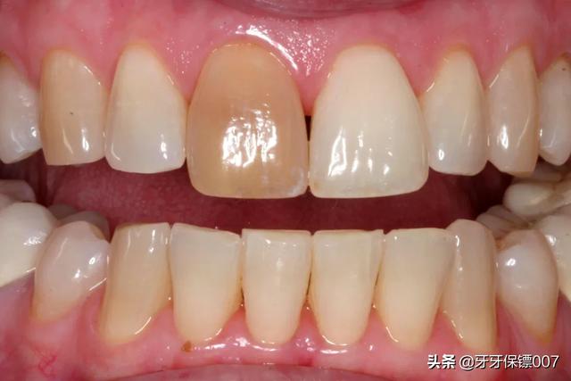 怎样使牙齿变白,如何使牙齿变白的简单方法