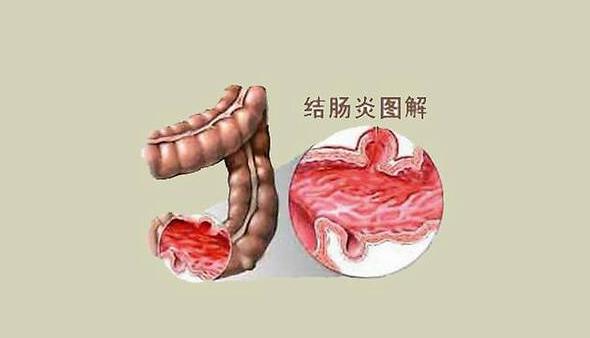 结肠炎的具体症状取决于特定结肠炎的原因,病程长短,严重程度等,典型