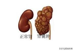 脚背穴位，肾囊肿吃什么中药比较管用？