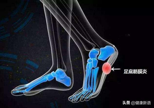 头条问答 - 早晨落地第一脚疼痛难忍,医生查出跟骨骨刺,患者将来还能