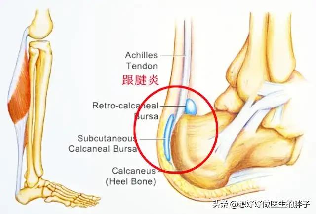 跑步尾巴根疼:朋友不能跑步，一跑步脚后跟就疼，快走也疼，请问这是怎么回事？