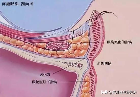 怎样快速去眼袋;怎么消除大眼袋