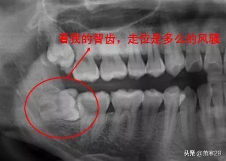 微创拔牙术前准备:拔牙术前准备工作有哪些? 都说拔牙对身体有影响，那么多长出的那颗智齿可以拔掉吗？