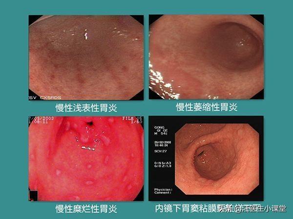 继而引起食欲下降,像你这样患了萎缩性胃炎却食欲很好的情况并不多见