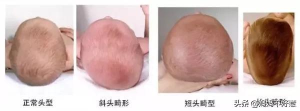 头条问答 - 宝宝头上窄下宽,怎么纠正?(8个回答)