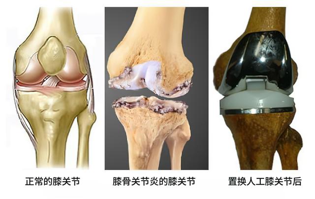 膑骨磨损是膝关节炎吗:痛风性关节炎和髌骨软化症的区别是什么？