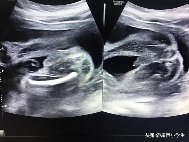 超典型的男宝特征，16周胎儿男女生殖器还能看出来了的吗
