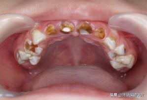 儿童补牙(儿童补牙一般多少钱一颗)