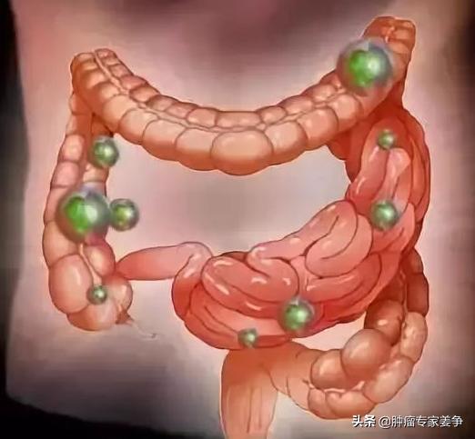 头条问答 为什么说肠癌是幸运癌 肿瘤专家姜争的回答 0赞