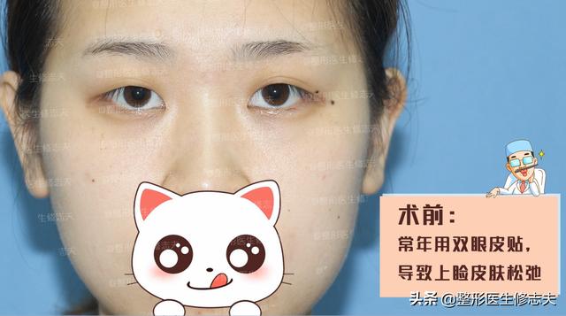 古巨基割双眼皮:长期贴双眼皮贴最后都会走上割双眼皮的路吗