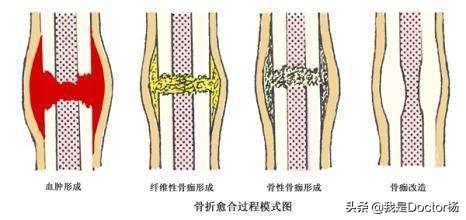 小腿轻微骨裂的症状:小腿骨裂纹保守治疗三个月，下地走路腿疼什么原因？