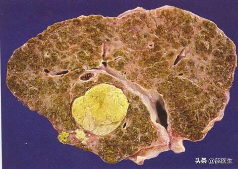 肝癌的早期症状和前兆，肝癌初期会有几种小毛病？