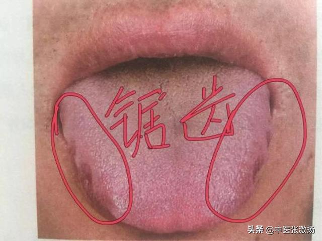 舌头胖大有齿痕，需要怎么调理？插图5